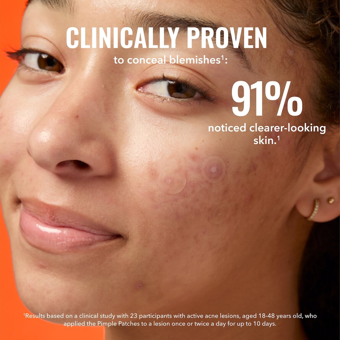 pimple-patches-w0 zb_p.jpg