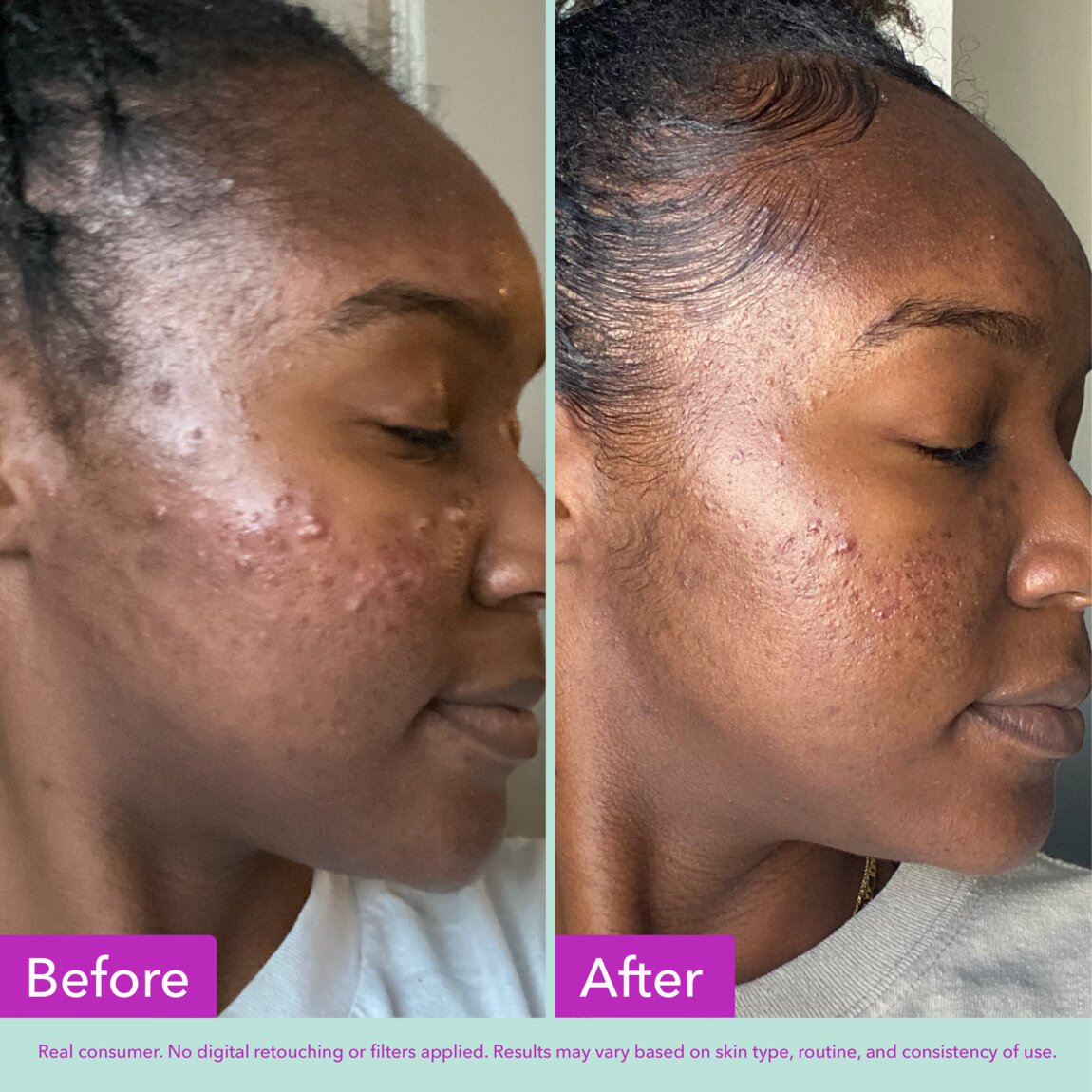 acne-foaming-cleanser-p6 zb_p.jpg